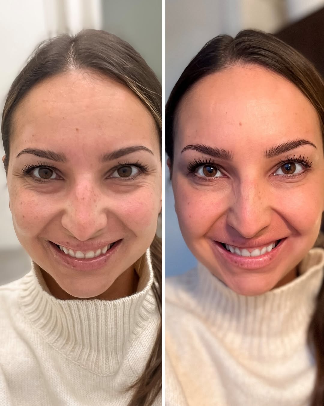 Botox-hoitoon valmistautuminen