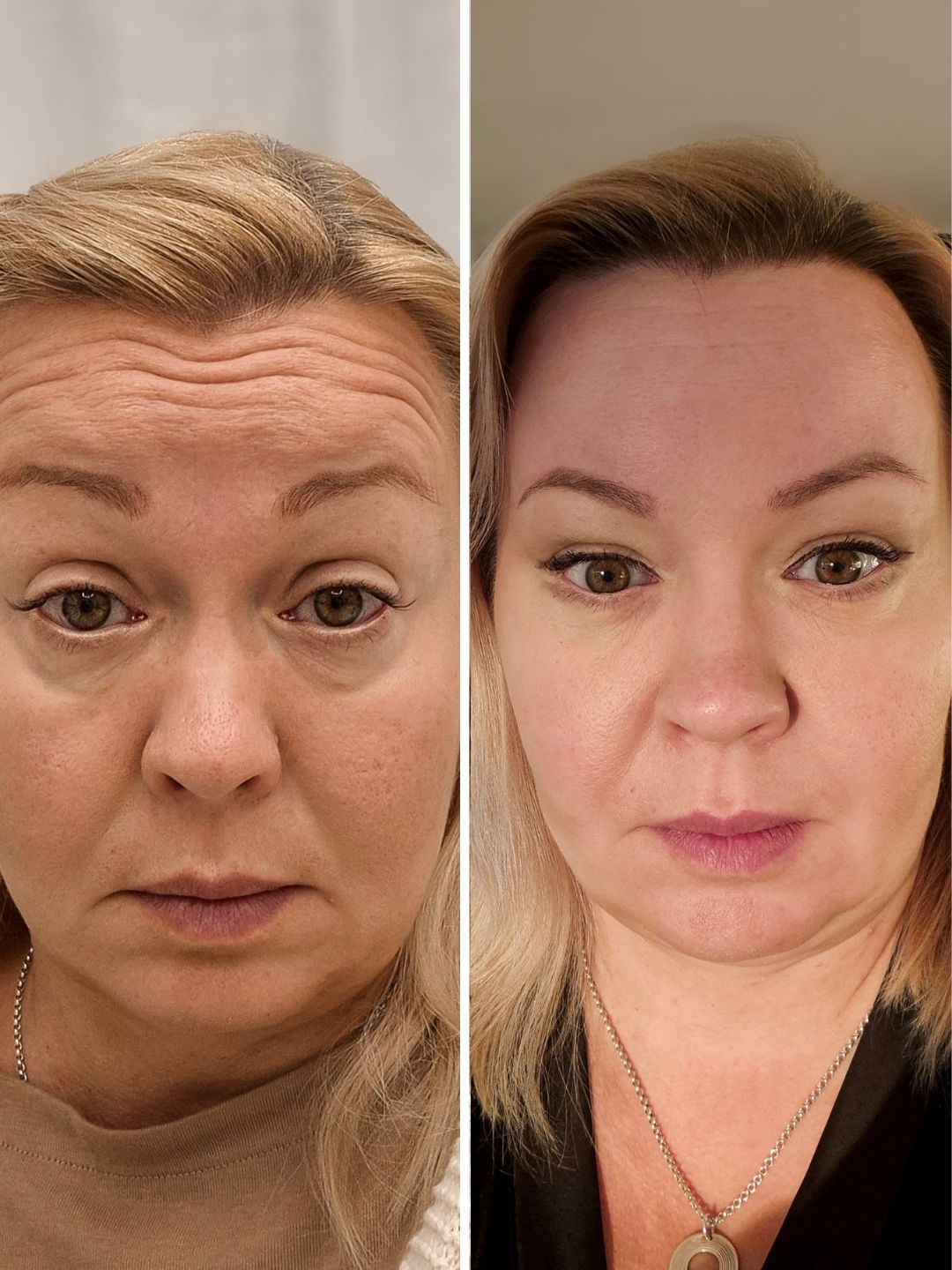 botox jälkihoito