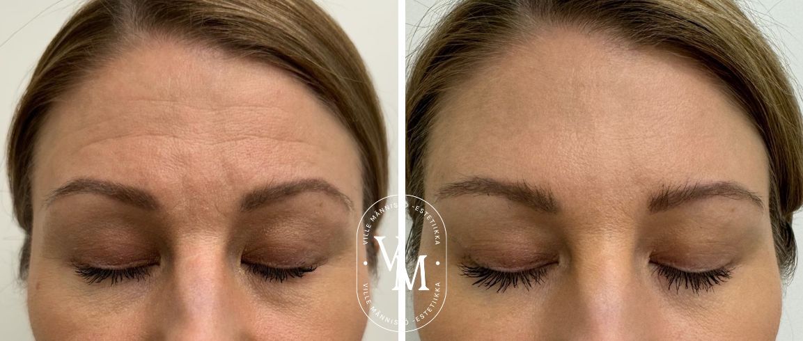 botox otsaan kokemuksia