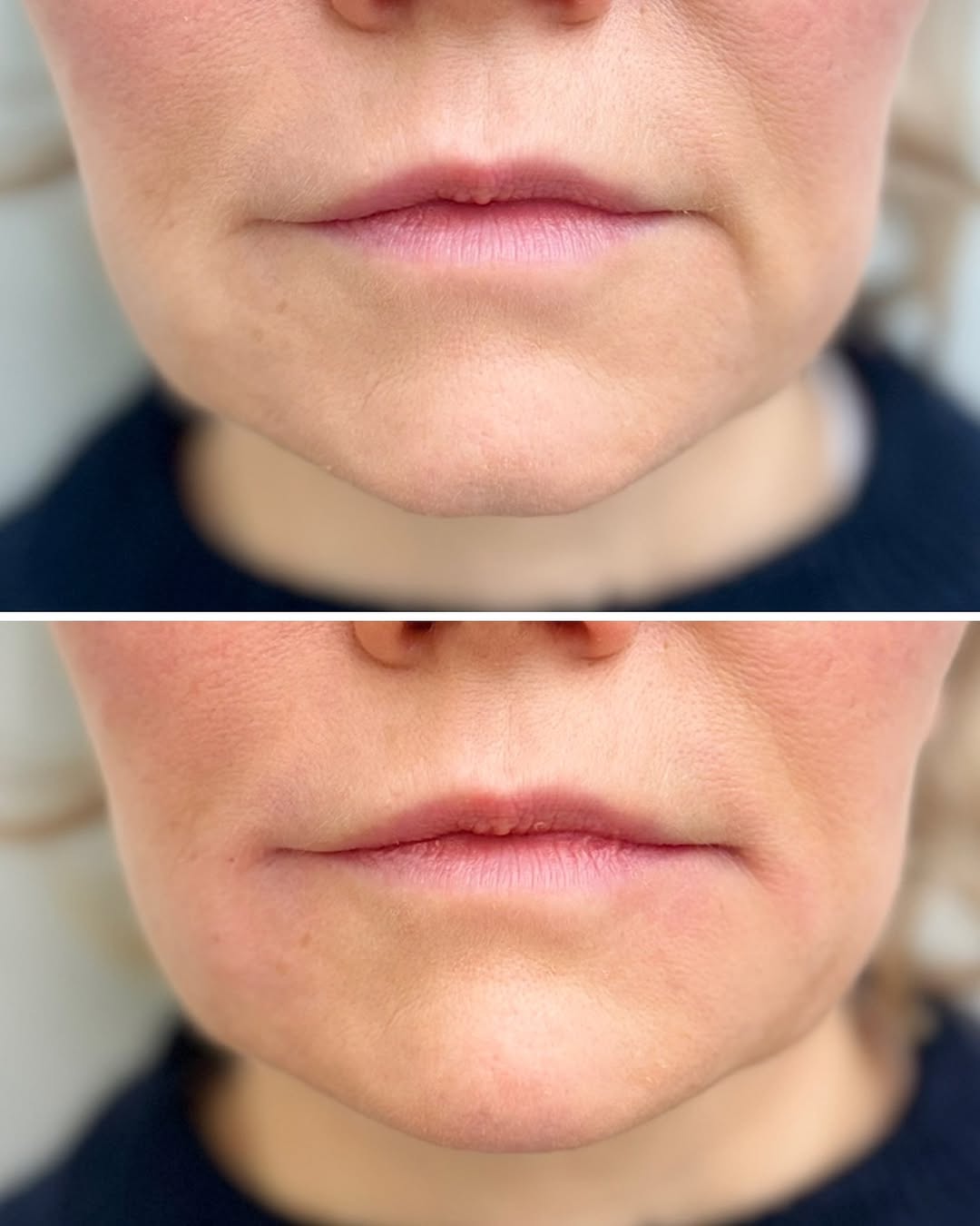 suupielien nosto botox