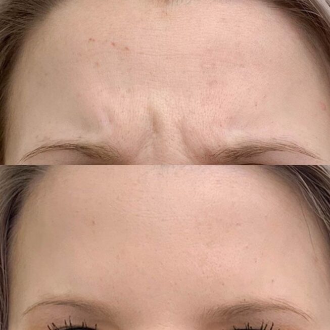 baby-botox-espoo-vmestetiikka