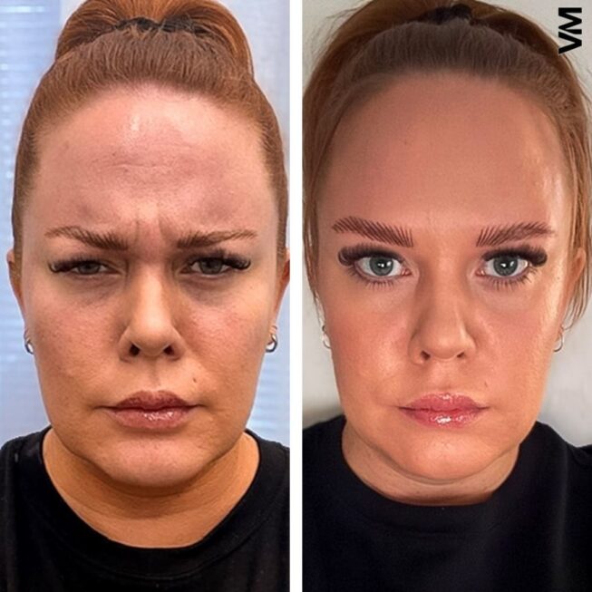 botox