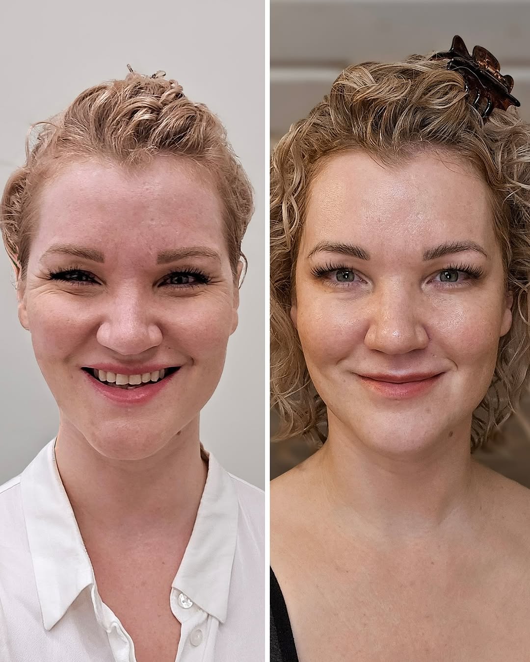 botox espoo ennen jälkeen