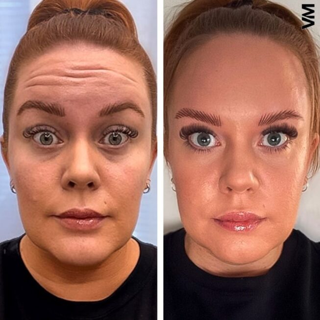 botox-espoo-ennen-jalkeen-2