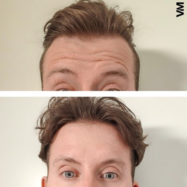 botox-espoo-ennen-jalkeen-vmestetiikka-1