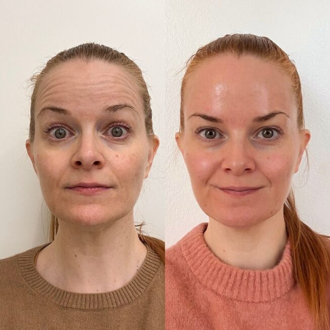 botox-espoo-ennen-jalkeen-vmestetiikka-10