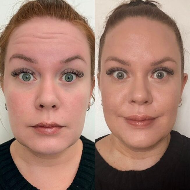 botox-espoo-ennen-jalkeen-vmestetiikka-11