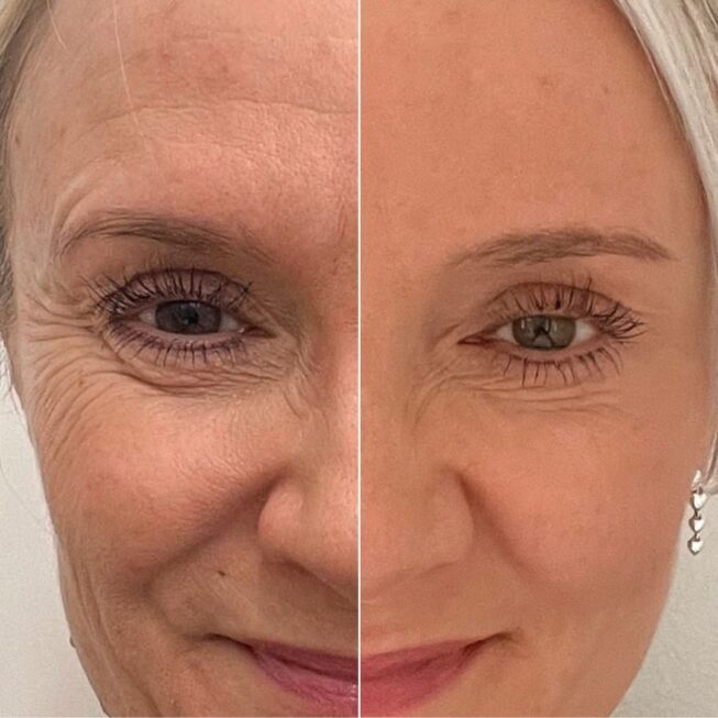 botox-espoo-ennen-jalkeen-vmestetiikka-12