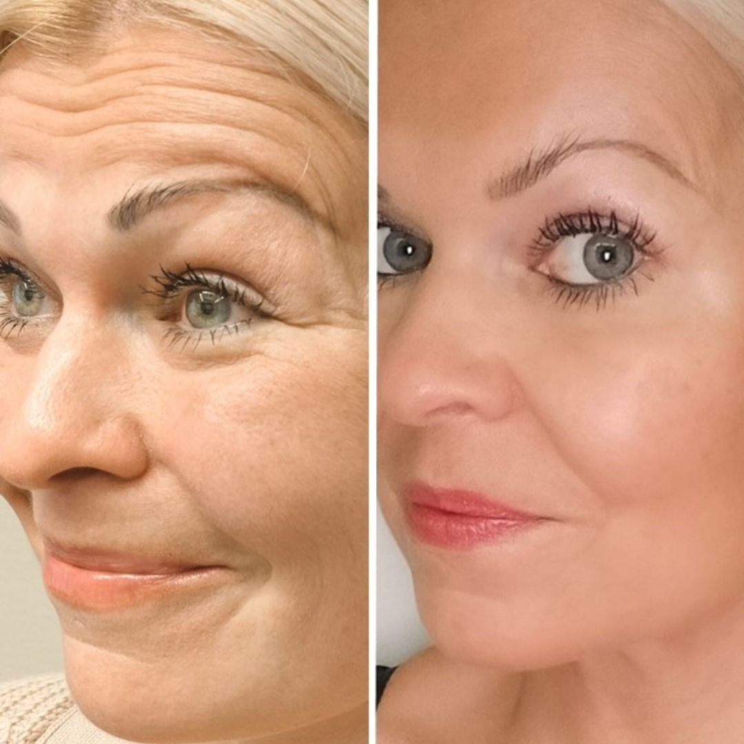 Botox otsaan Espoo VM-estetiikka Ville Männistö