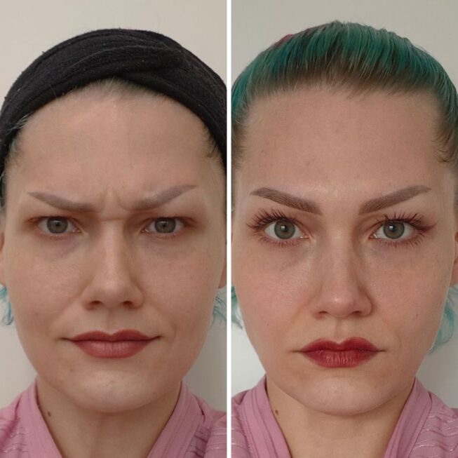 botox-espoo-ennen-jalkeen-vmestetiikka-4