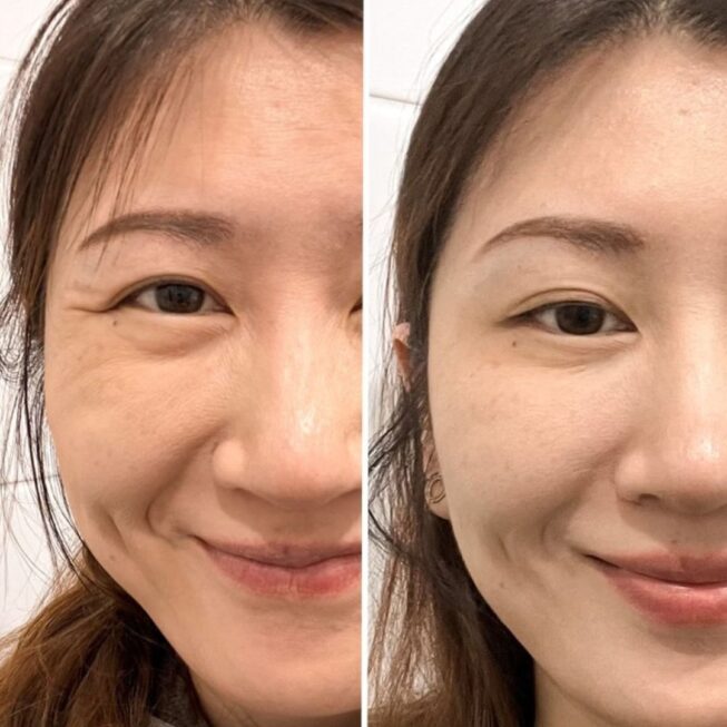 botox-espoo-ennen-jalkeen-vmestetiikka-5