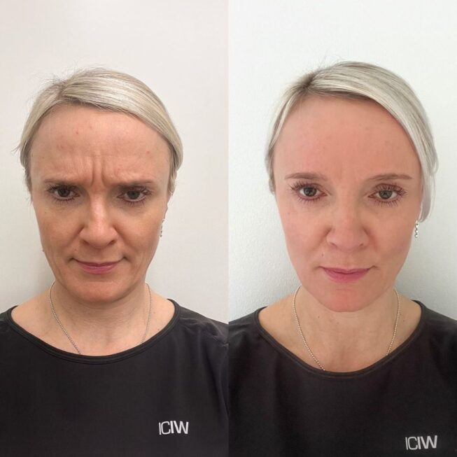 botox-espoo-ennen-jalkeen-vmestetiikka-6