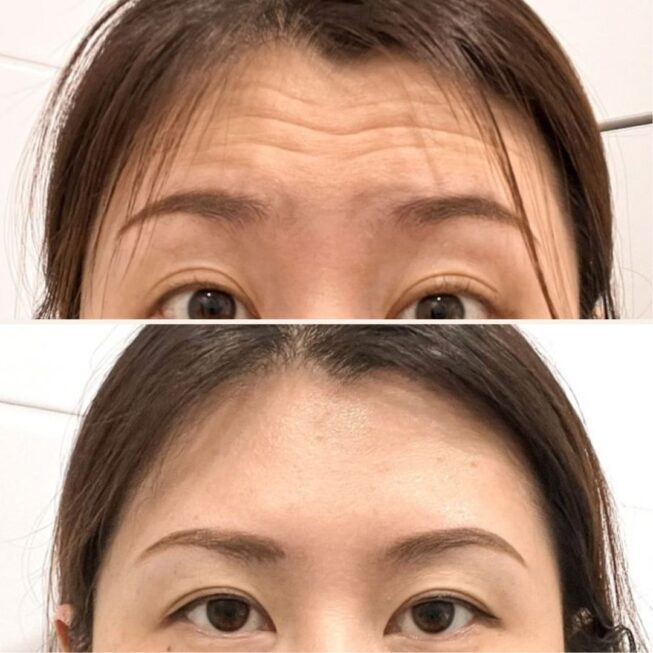 botox-espoo-ennen-jalkeen-vmestetiikka-7