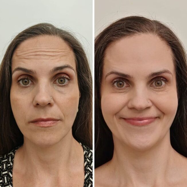 botox-espoo-ennen-jalkeen-vmestetiikka-9