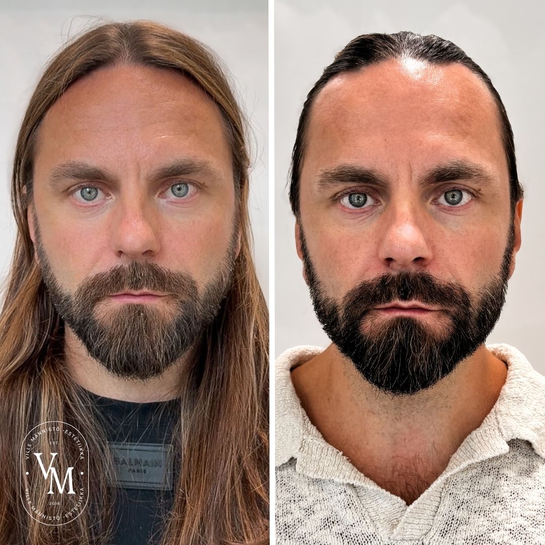 Botox Helsinki, Botox Espoo, Botox Vantaa