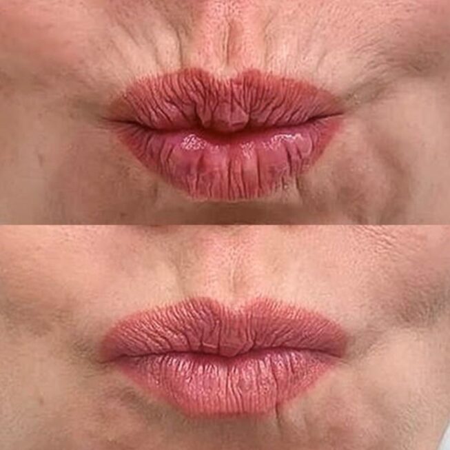 botox-huulet-espoo-vmestetiikka-2