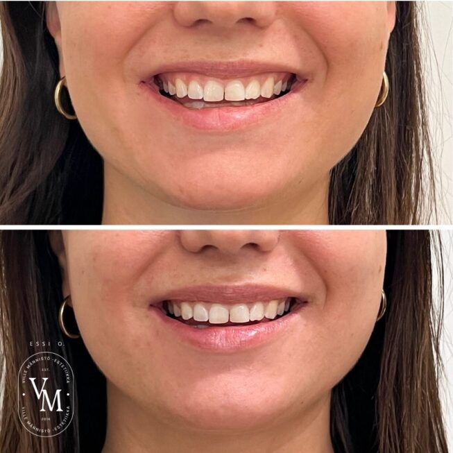 Botox Lip Flip