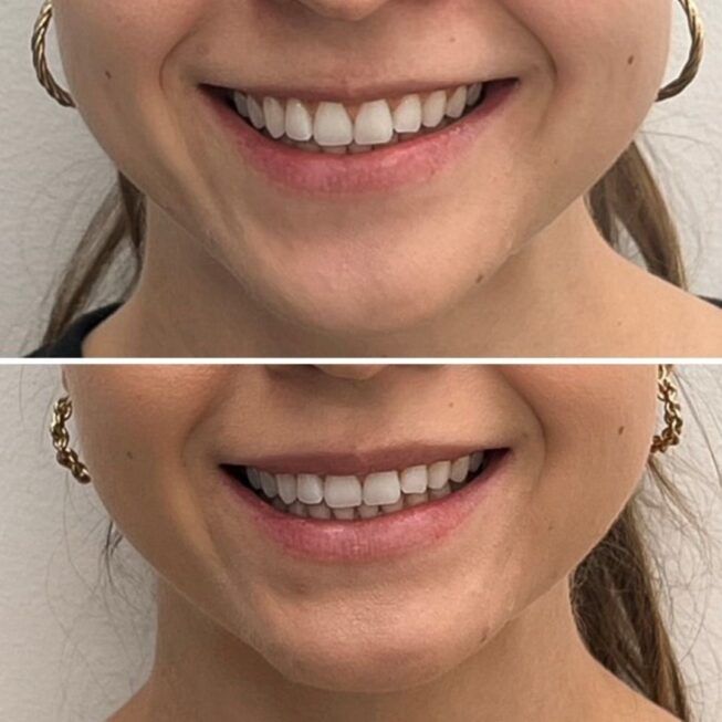 botox-lip-flip-espoo-essi-ojala
