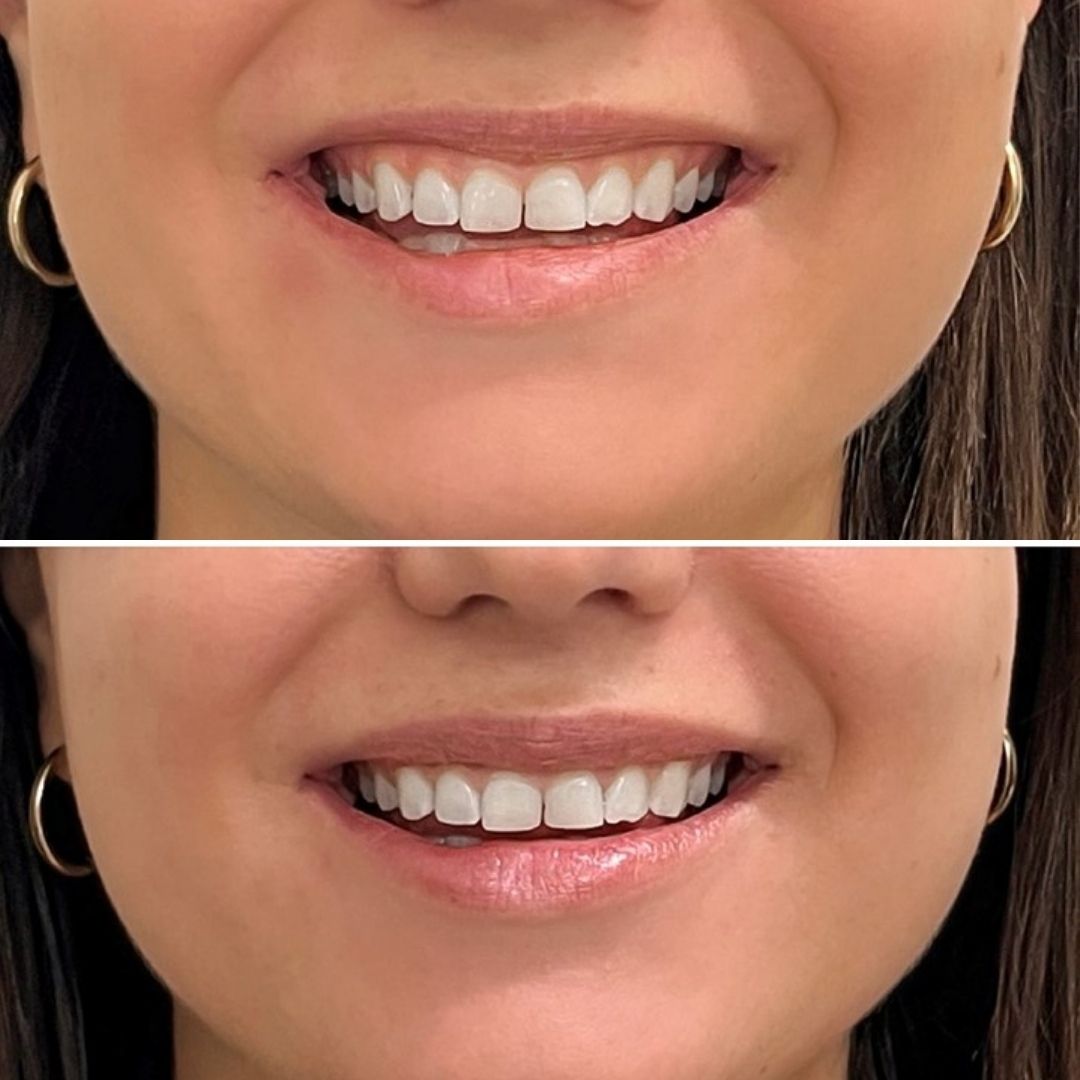 botox huulet