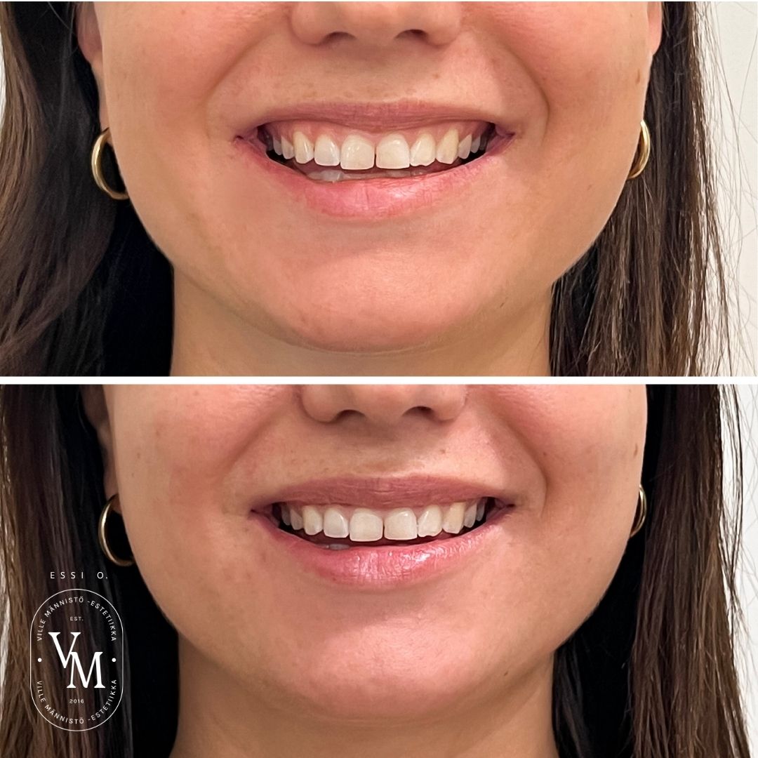 Botox lip flip price: 270 €