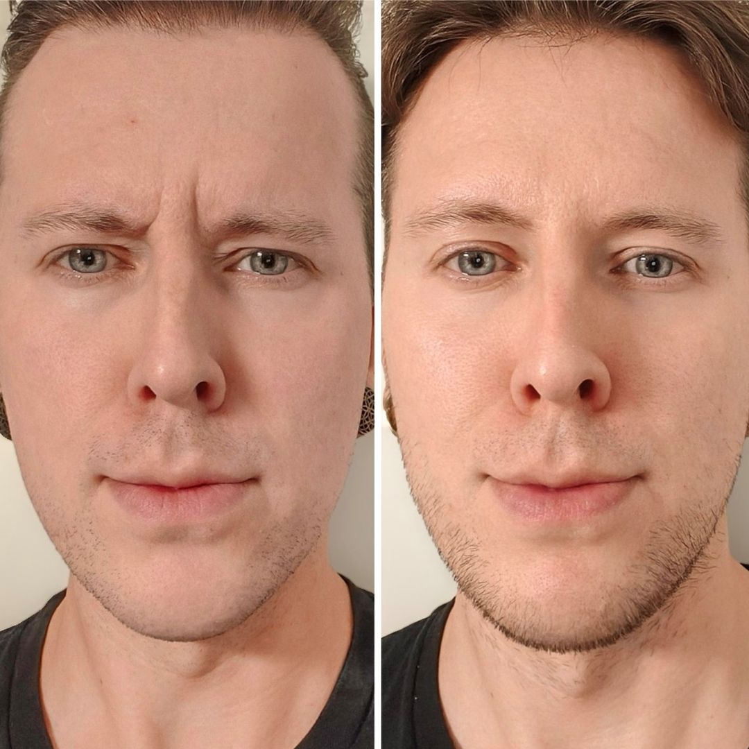 botox espoo