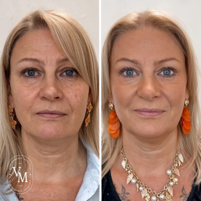 Botox for the Forehead - Botox in Helsinki