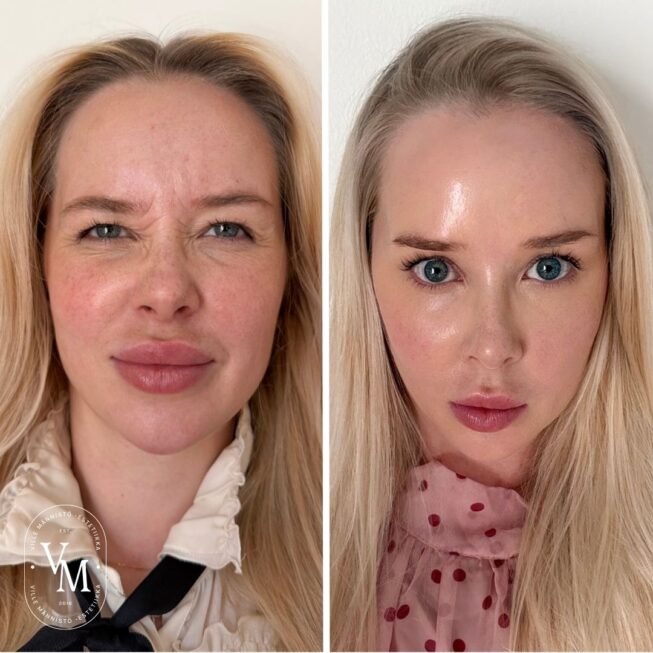 Botox on the Forehead: Before and After (1)