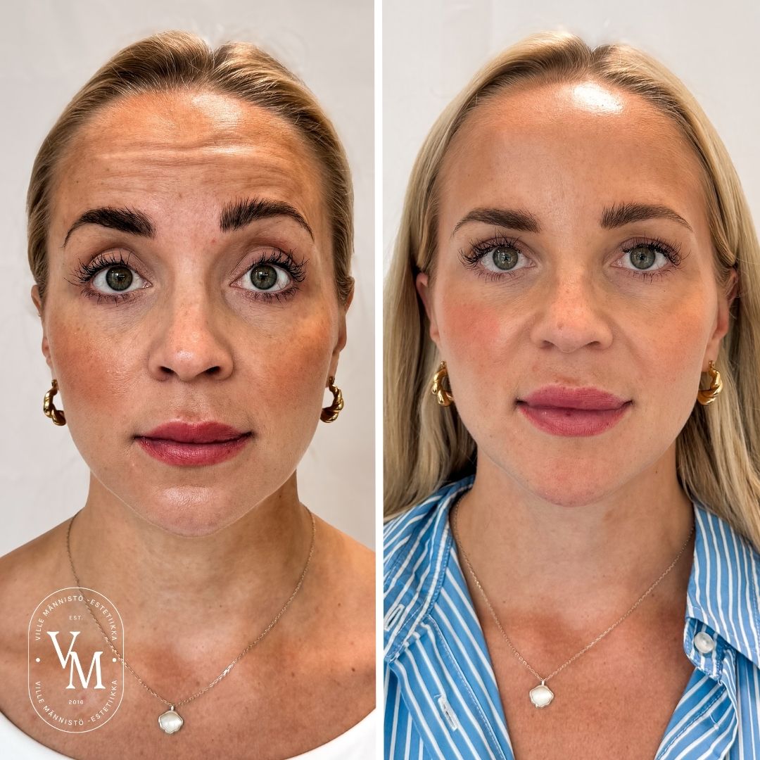 Botox Espoo, Botox Helsinki, Botox Vantaa