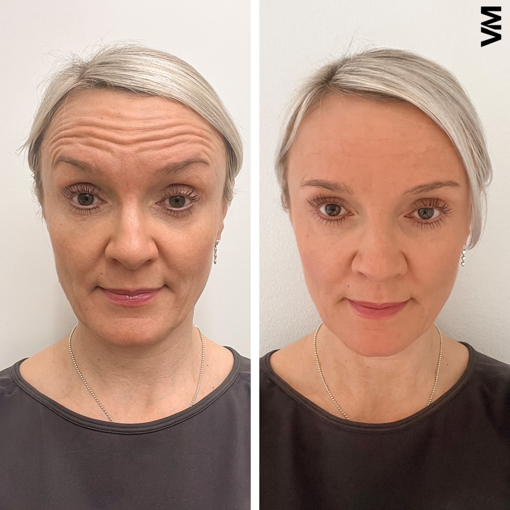 botox espoo