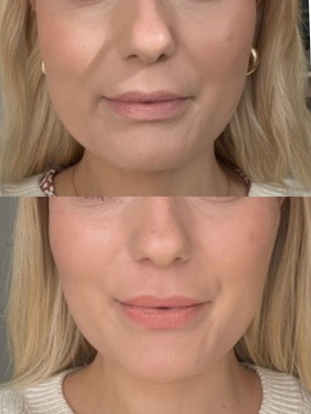 bruksismi botox purentalihaksiin