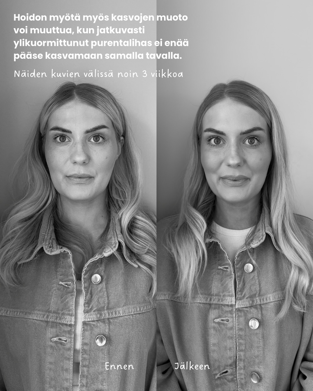 bruksismi botox purentalihaksiin