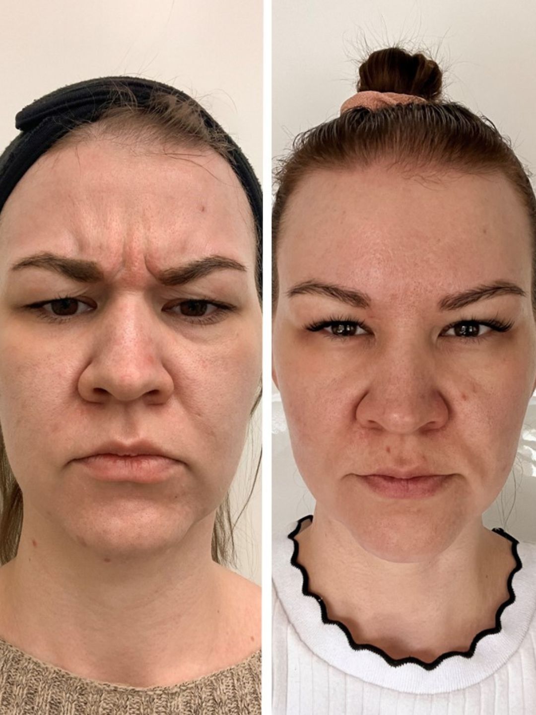 sibeliusryppy botox espoo