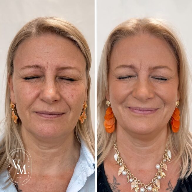 Sibelius Wrinkle Botox Tampere