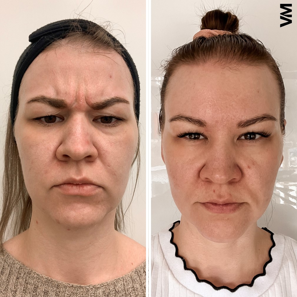 Sibeliusryppy botox ennen jälkeen Ville Männistö