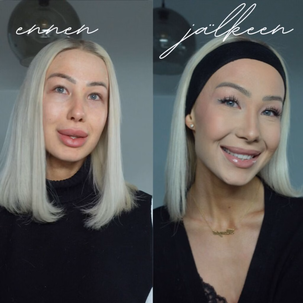 Huulitäytteiden poisto Espoo ennen ja jälkeen