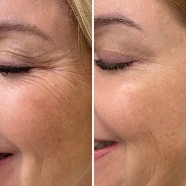 botox-espoo-harakanvarpaat-ennen-jalkeen