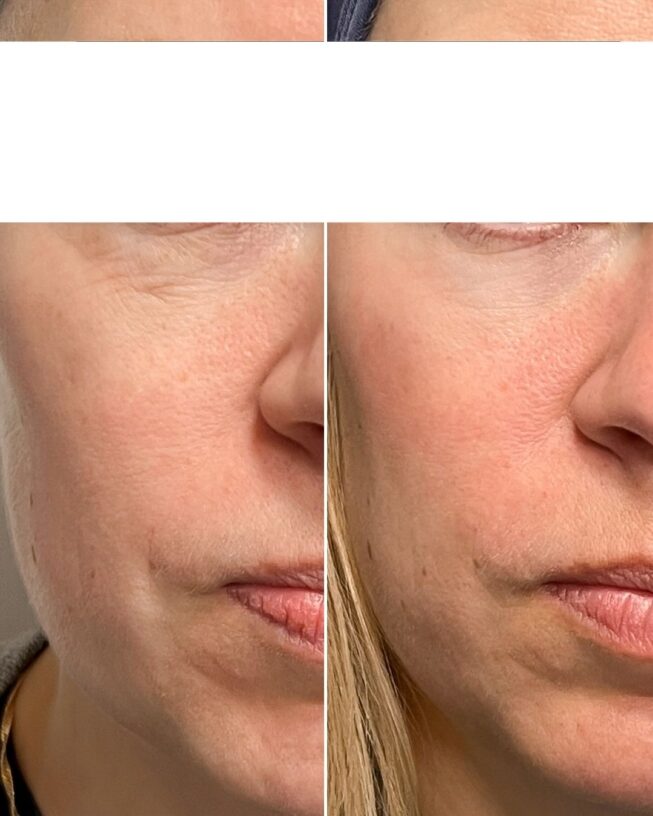 Before-and-After Profhilo Experiences