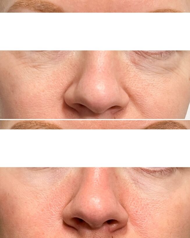 Before-and-After-Profhilo Experiences