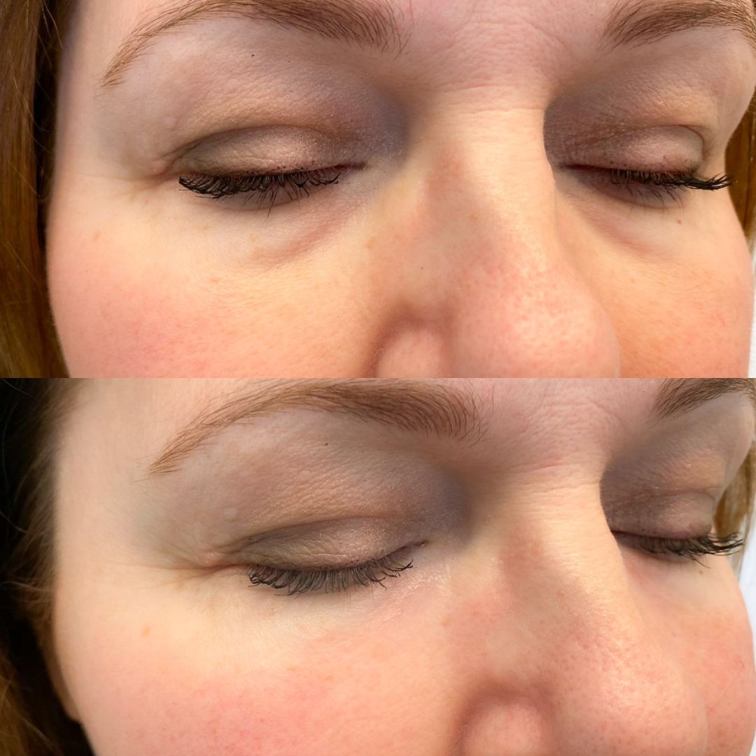 Dark circles under the eyes, tear trough filler