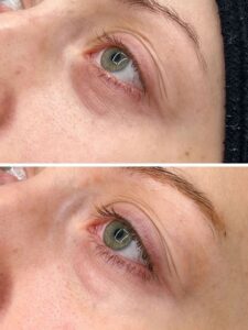 Experiences with polynucleotide therapy: before and after