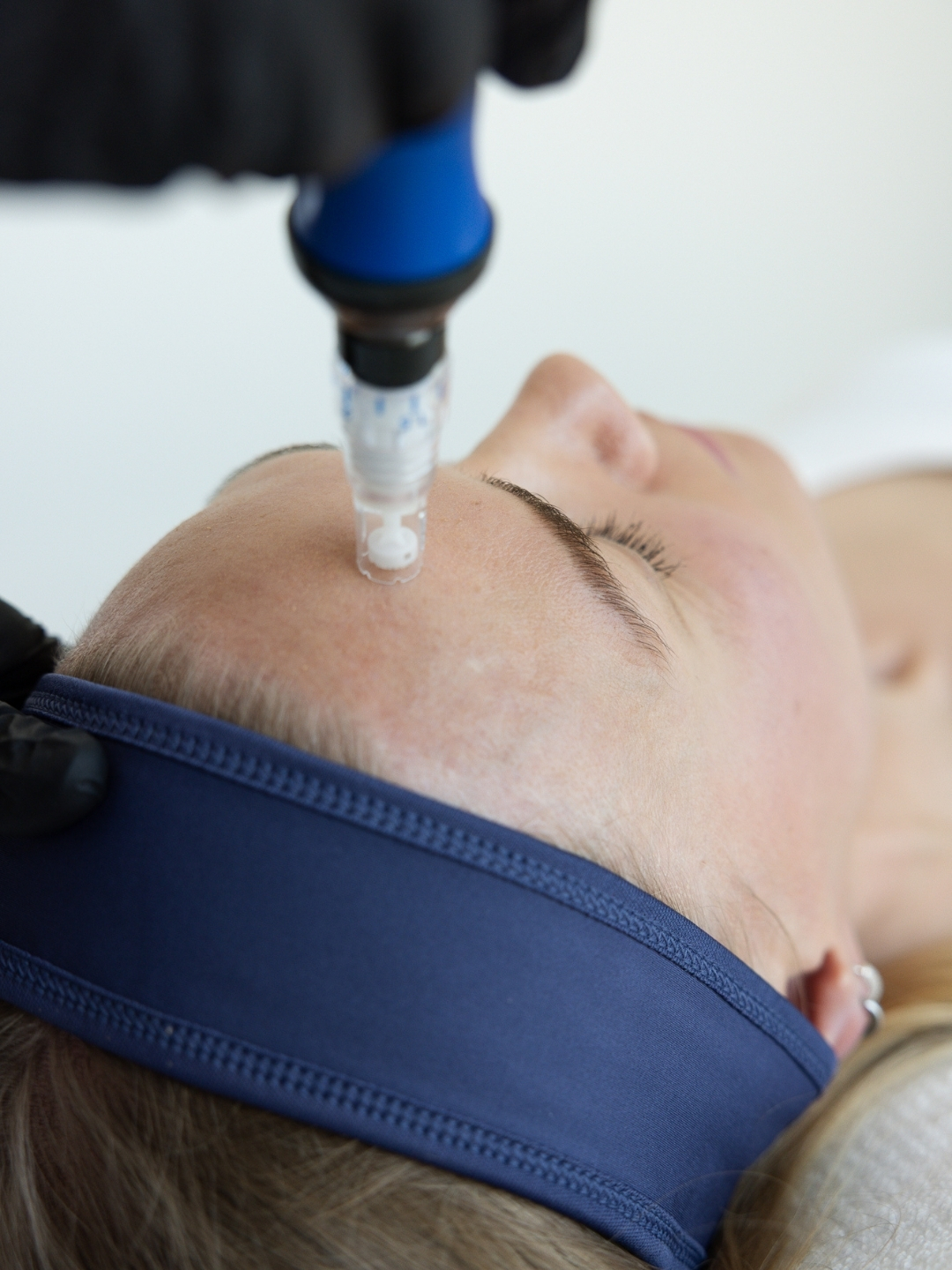 skinpen-mikroneulaus espoo