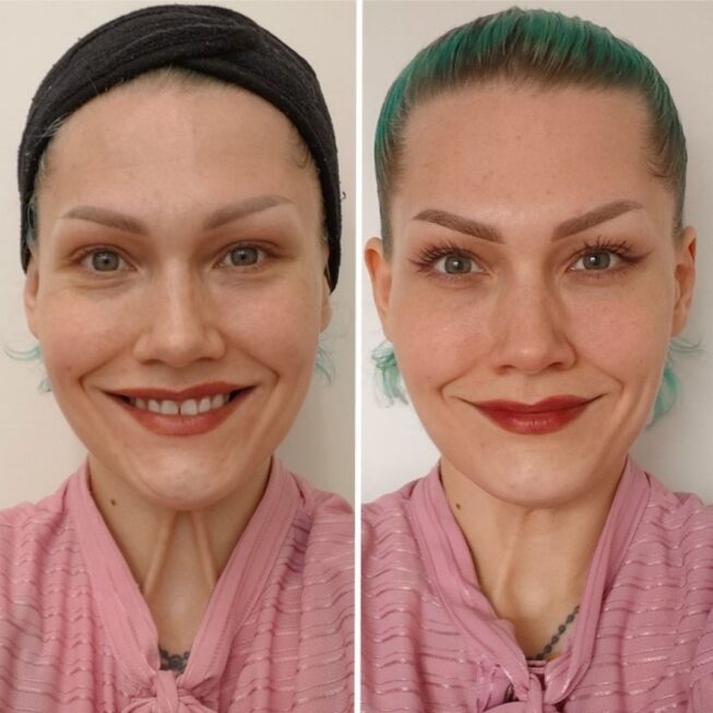 baby-botox-hinta