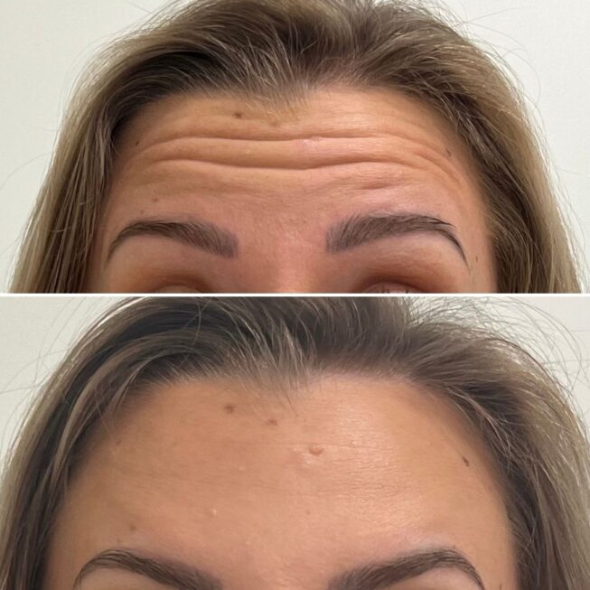 botox-espoo-essi-ojala