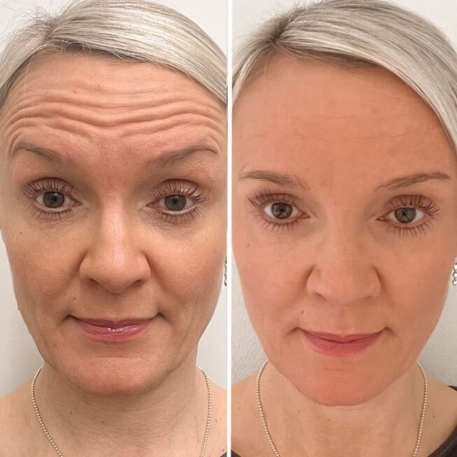 botox-hinta-vm-estetiikka