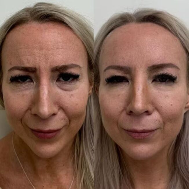 botox-kokemuksia-2