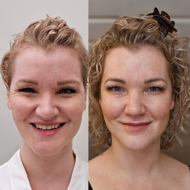botox-kokemuksia-ville-mannisto (2)