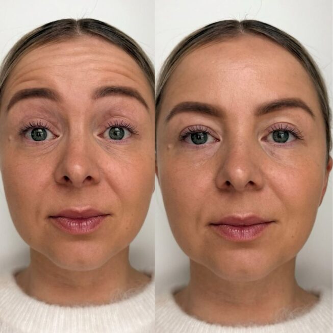 botox-kokemuksia-ville-mannisto