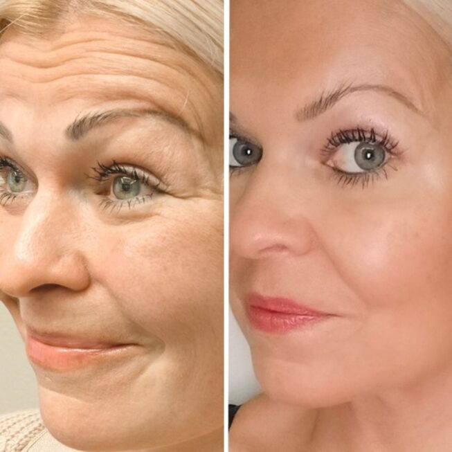 botox-kulmien-romahdus-vs-oikein-tehty-hoito