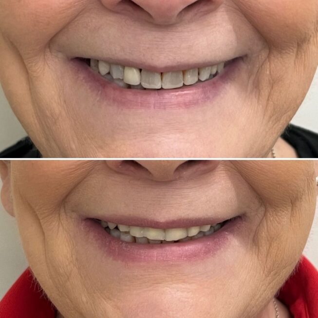 botox-lip-flip-essi-ojala