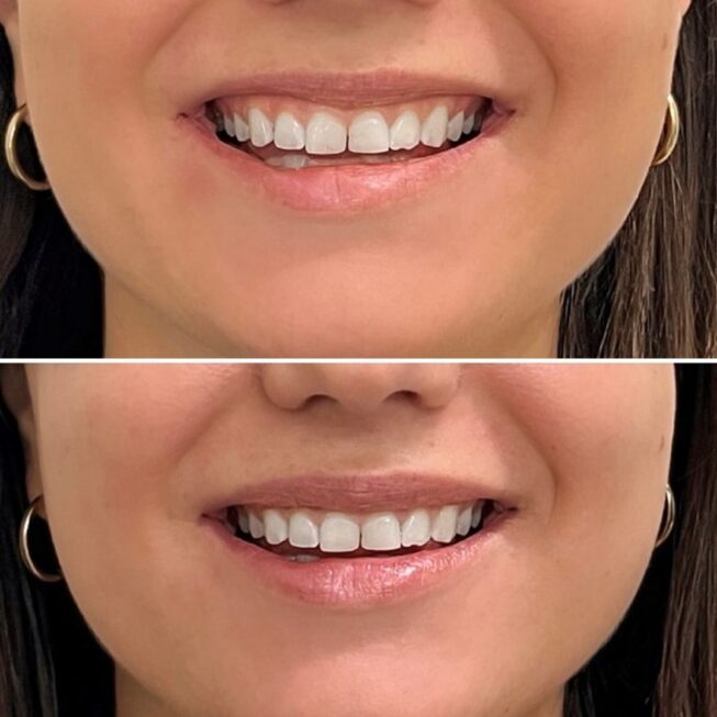 botox-lip-flip-hinta-270-€